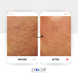 acne procell result